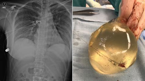 Womans Breast Implant Deflects Bullet Saving Her Life