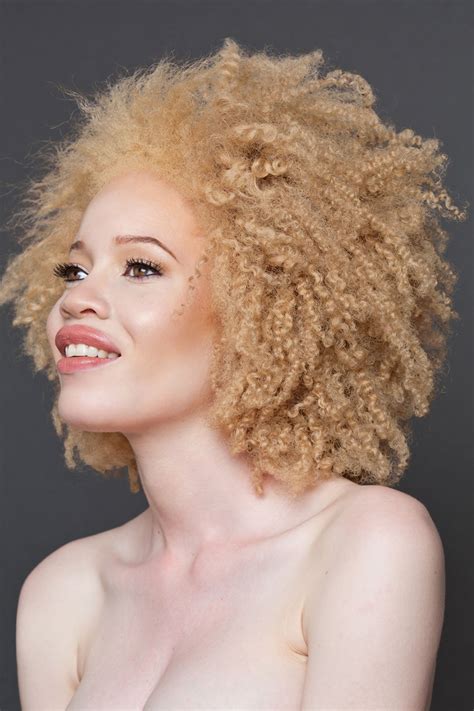 Freckled Albino Porn Pic Telegraph