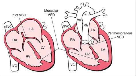 Vsd Types Ventricular Septal Defect Heart Defect Medi