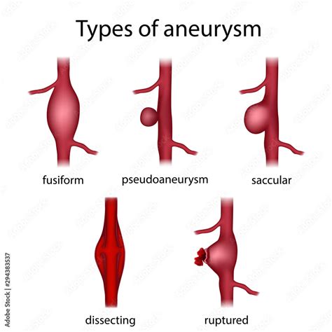 Types Of Aneurysm Fusiform Pseudoaneurysm Saccular Dissecting
