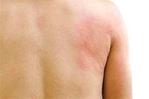 Chronic Autoimmune Illnesses Linked to Chronic Hives | Chronic hives