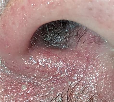 Very Small White Cluster Of Pustules Inside My Nose Warning Graphic