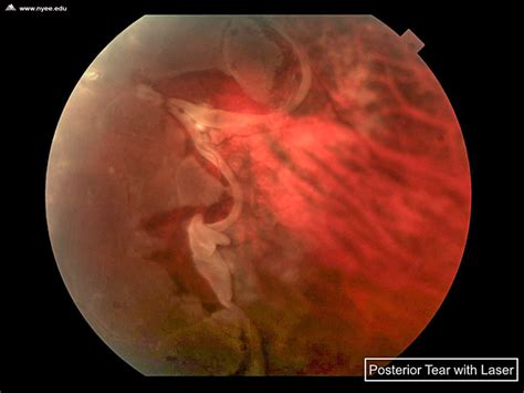Treatment can reduce the risk of a tear progressing to a retinal detachment to about one percent. Posterior Retinal Tear (3 of 5) - NYEE