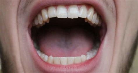 Bump Or Lump On The Roof Of Mouth Causestreatmenthome Remedies