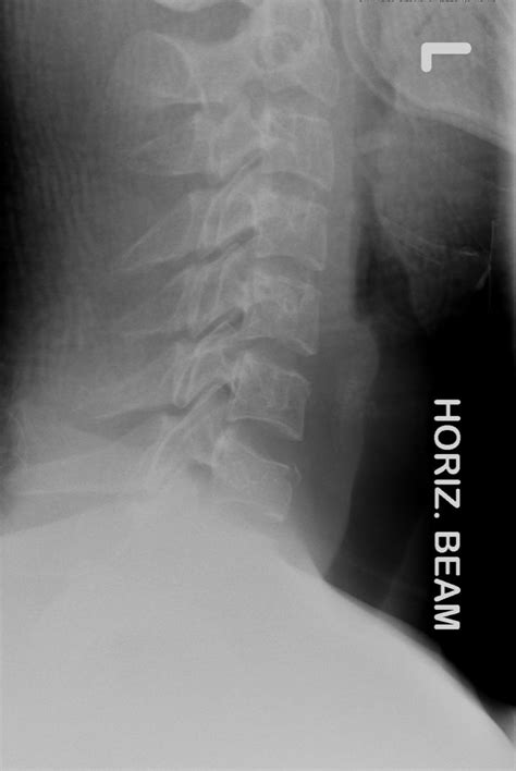 The Cervical Spine