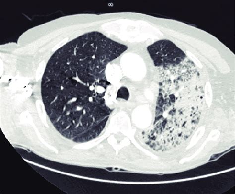 Chest Ct Showing Consolidation Predominantly In The Left Lung