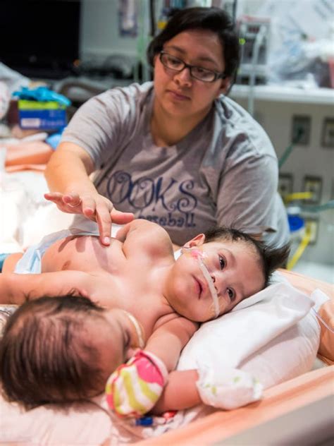 Conjoined Twins Move Closer To Separation Surgery