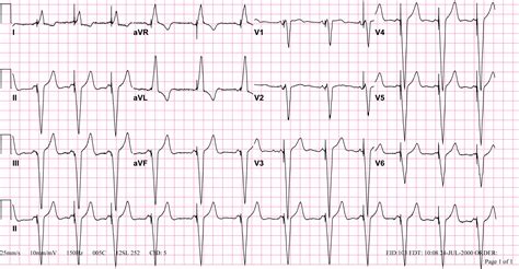 The Ekg In A Patient With A Pacemaker Wikidoc