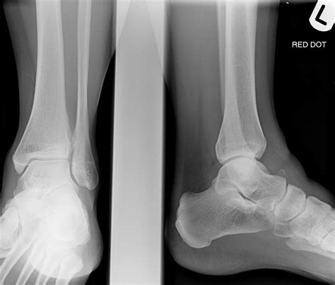 Normal Foot Xray Lateral