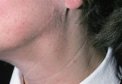 Swollen Glands Lymphadenopathy In Woman S Neck Stock Image M200 0095 Science Photo Library