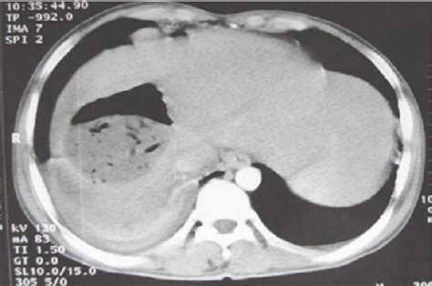 Figure 1 From Resolution Of Hepatic Hydatid Cyst Following Spontaneous