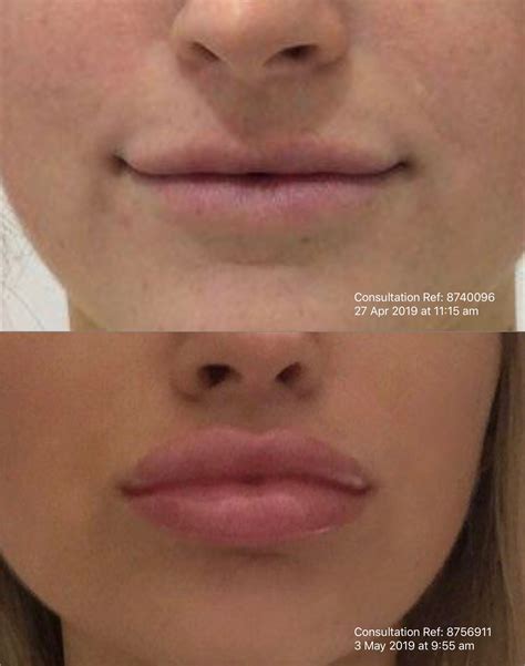 Lip Enhancement Injectables Gold Coast Oo La La Cosmetic And Laser Clinic