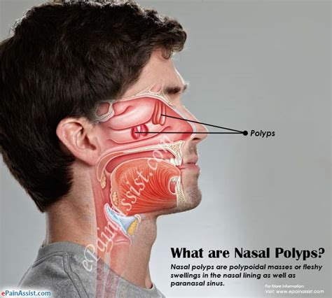 What Are Nasal Polyps Know Its Causes Symptoms Treatment