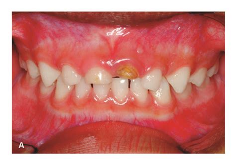 A Facial View Of Traumatized Teeth Enamel Dentin Pulp Fracture Of