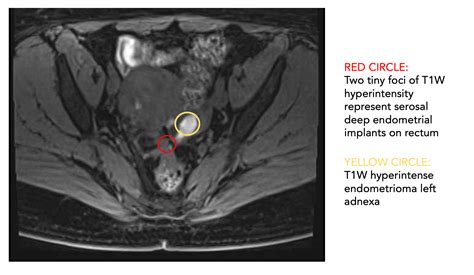 Endometriosis Getting Answers With Mri