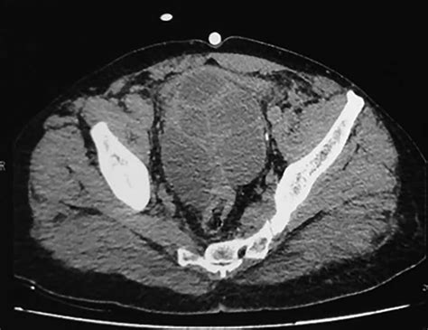 Ct Scan Showing Pelvic Multilocular Heterogeneous Cystic Mass With Many