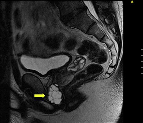 Large Symptomatic Periurethral Cystic Lesion In A Male Urology
