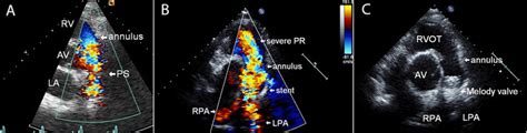 A Transthoracic Echocardiographic Image Parasternal Short Axis View