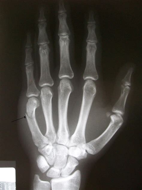 Boxer S Fracture