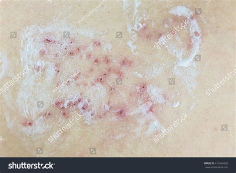 Raised Red Bumps Blisters On Skin Stock Photo 411664228 Shutterstock