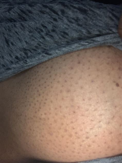 Skin Concerns Dark Spots On My Chest And How To Get Rid Of Them I