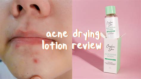 Acne Drying Lotion By Careline Skin Review 7 Day Test Youtube