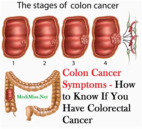 Colon Cancer Symptoms How To Know If You Have Colorectal Cancer