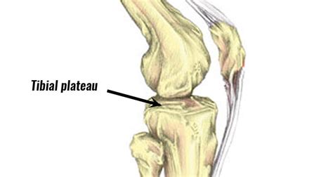 Tibial Plateau Fracture Physical Therapy Exercises Online Degrees