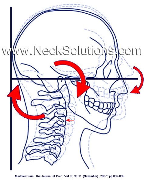 Neck Exercises Key To Pain Relief And Restoration