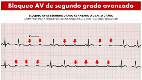 Cardiotruco Bloqueos Av Cardioprimaria Ferrol