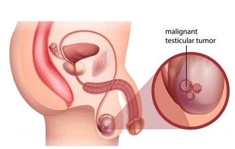Testicular Cancer Treatment Market Research Report 2020 Growth Recent