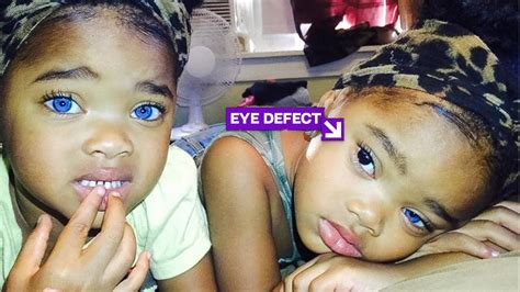 Do You Remember The Blue Eyes Twins See How They Look Like Today Youtube