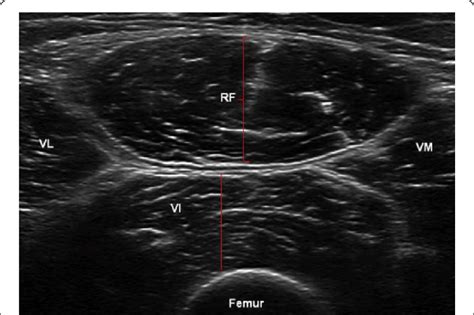 The Muscle Layer Thickness Detected By Ultrasound Quadriceps Femoris