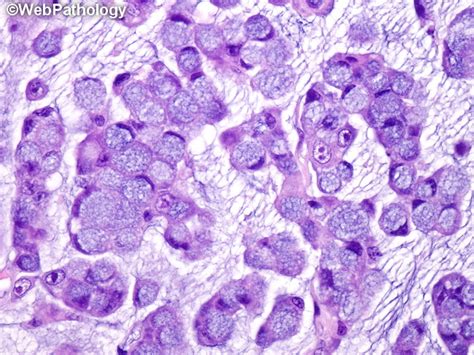 Share More Than 55 Signet Ring Cell Adenocarcinoma Appendix Vn