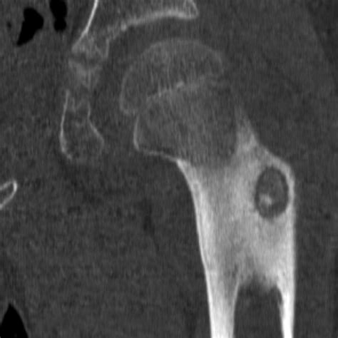 Osteoid Osteoma Wikidoc
