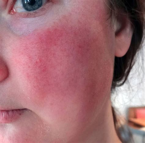 Scarlet Letters Dealing With Vascular Rosacea Face Flushing Burning