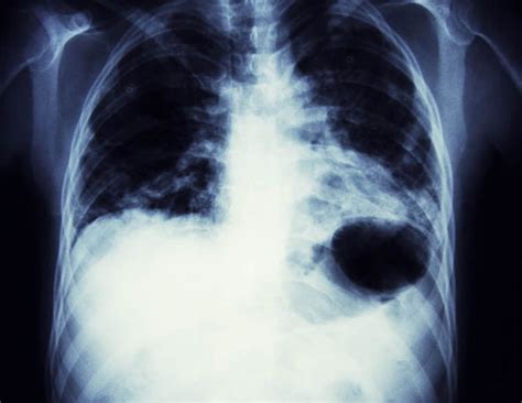A specialist can arrange more tests to. Lung cancer survival rates are 'lagging' in the UK ...