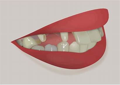 Dental Animation Implants Zirconia Bridge Before Implant