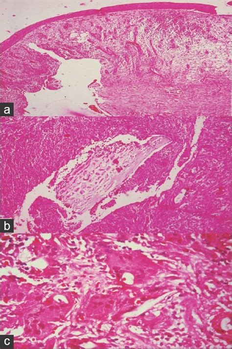 A Photomicrograph Showing Cystic Cavity Of Odontogenic Keratocyst H