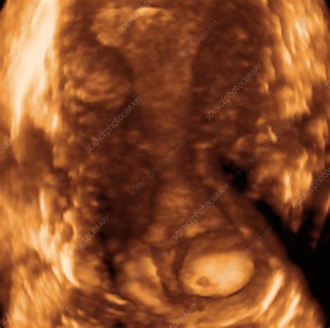 Cervical Cyst Ultrasound Scan Stock Image M8500535 Science