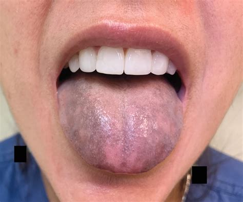 Tongue Discoloration Nejm