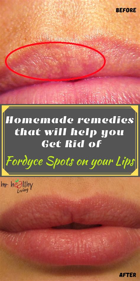 How To Get Rid Of Bumps On Lips