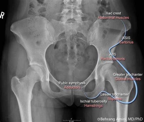 Avulsion Fractures Can Occur At Many Points In The Pelvis Going