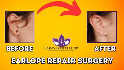 What Is Earlobe Repair Surgery And Its Benefits Youtube