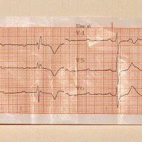 The ECG Of The Patient Showing The Complete Atrioventricular Heart Block Download Scientific