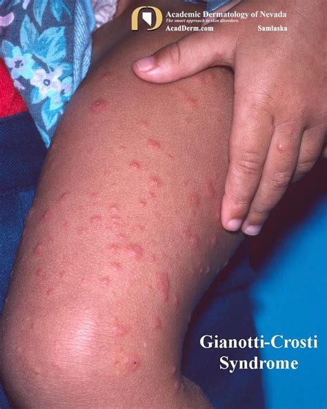 Gianotti Crosti Syndrome Academic Dermatology Of Nevada