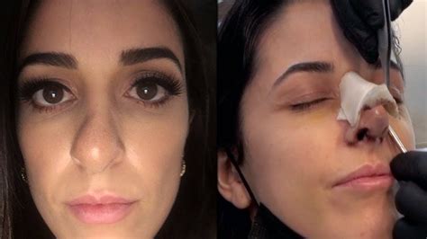 My Nose Job Reveal And 2 Weeks Post Op Revision Rhinoplasty Experience