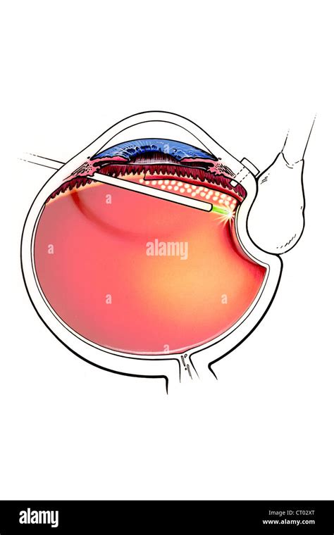 Retinal Detachment Surgery Stock Photo Alamy