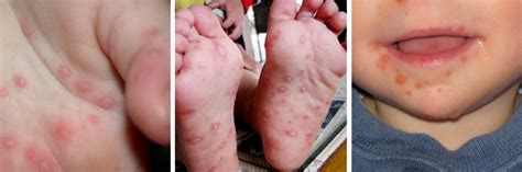 Hand Foot And Mouth Disease