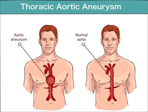 Thoracic Aortic Aneurysm And Aortic Dissection Marfan Foundation